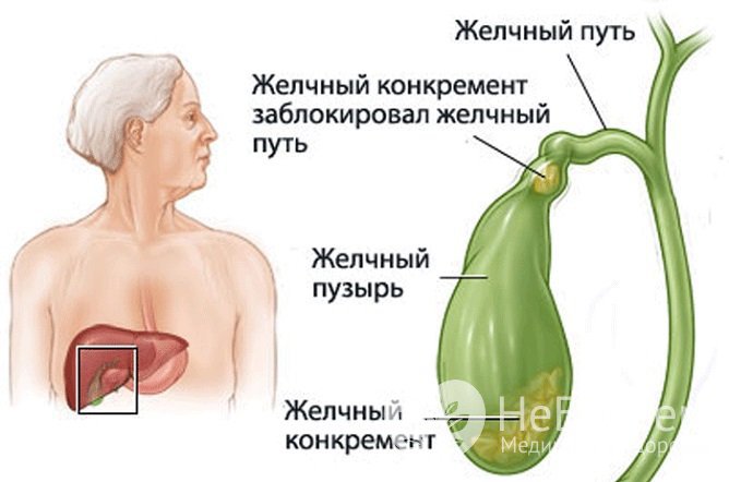 Обструкция желчных путей – причина механической желтухи