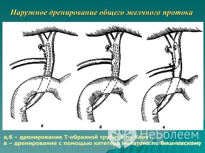 Наружное дренирование желчных путей по Керу при механической желтухе