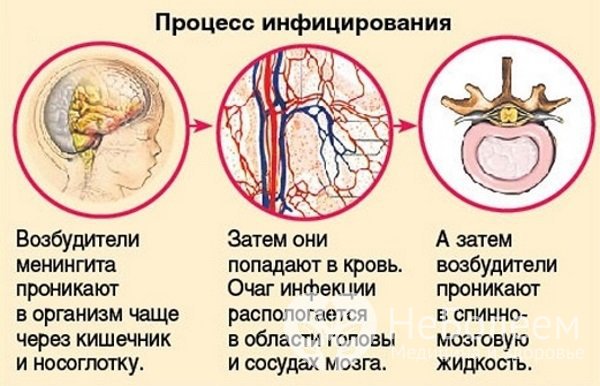 Процесс инфицирования менингитом