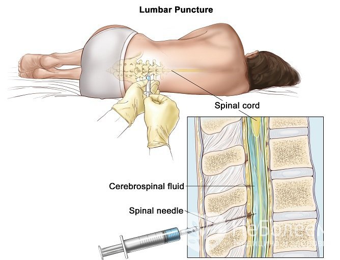 Люмбальная пункция – важный метод диагностики менингита у детей