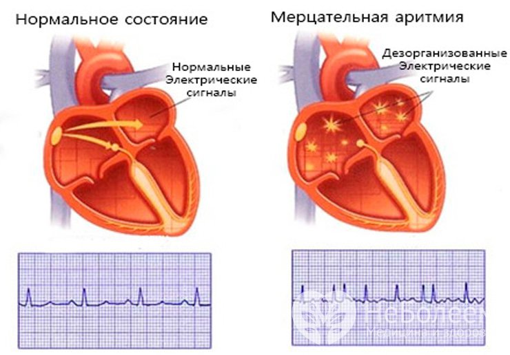 Признаки мерцательной аритмии