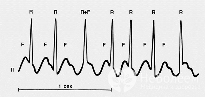 Трепетание предсердий на ЭКГ