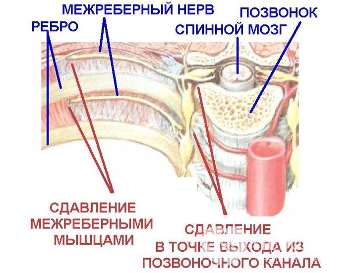 Признаки межреберной невралгии