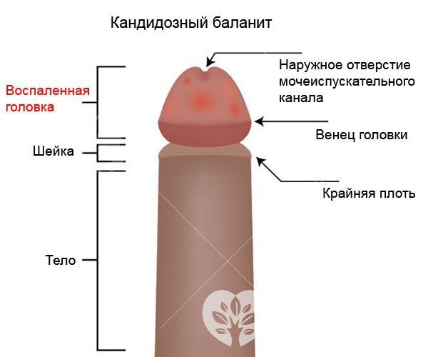 Кандидозный баланит – одна из форм молочницы у мужчин