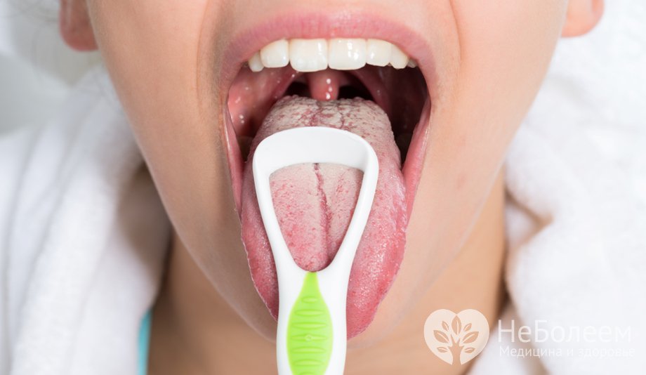 Признаки молочницы полости рта