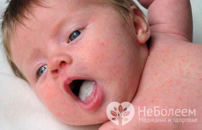 Молочница у детей проявляется характерным налетом в ротовой полости или на половых органах