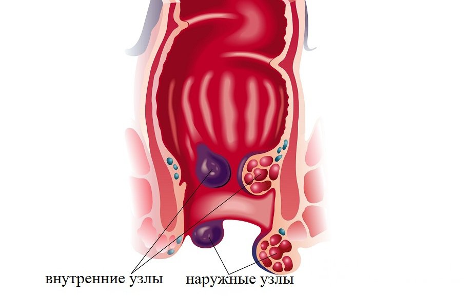 Признаки наружного геморроя