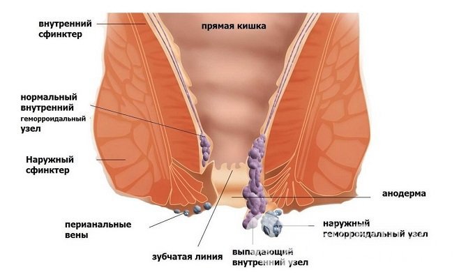 Наружный геморрой 3 стадии