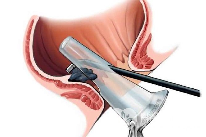 Аноскопия – один из методов диагностики наружного геморроя