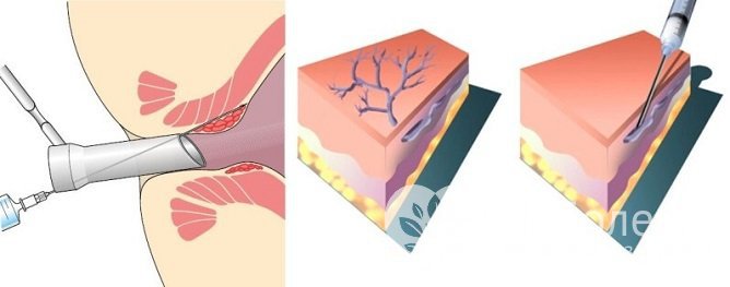 Склеротерапия – малоинвазивная методика удаления наружных геморроидальных узлов
