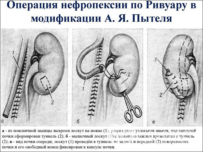 Один из методов оперативного лечения нефроптоза – нефропексия по методу Ривуара