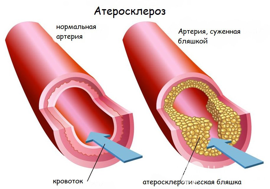 Признаки облитерирующего атеросклероза