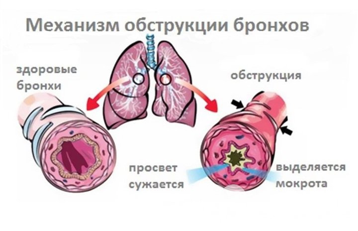 Признаки обструктивного бронхита у детей