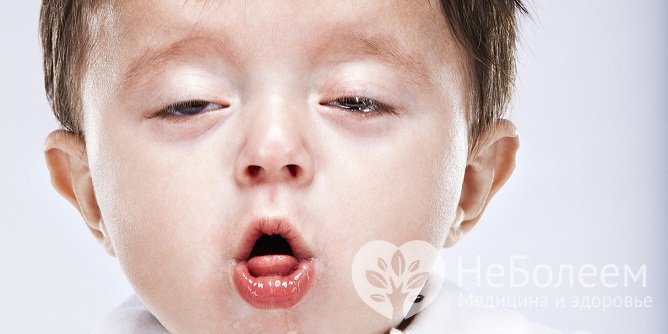 Навязчивый приступообразный сухой кашель у ребенка может быть симптомов обструктивного бонхита