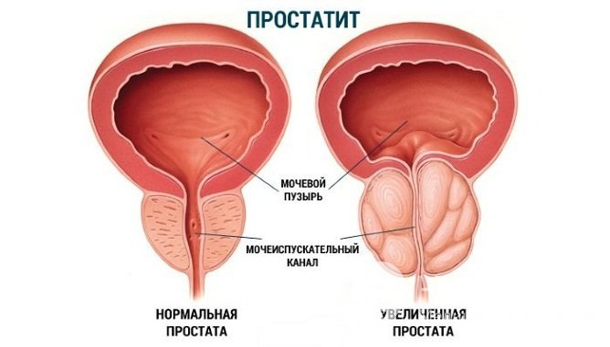 Простатит может быть причиной олигурии у мужчин