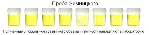 Функциональное исследование мочи проводят при подозрении на патологическую олигурию