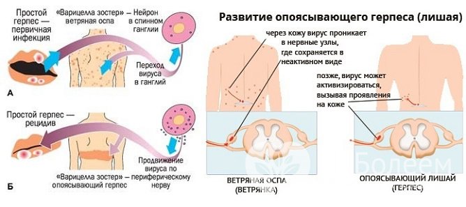 Причины опоясывающего герпеса 