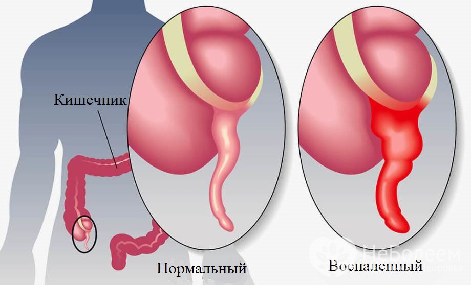 Признаки острого аппендицита