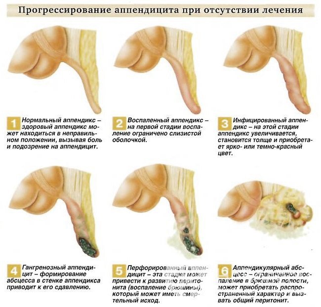 Стадии острого аппендицита