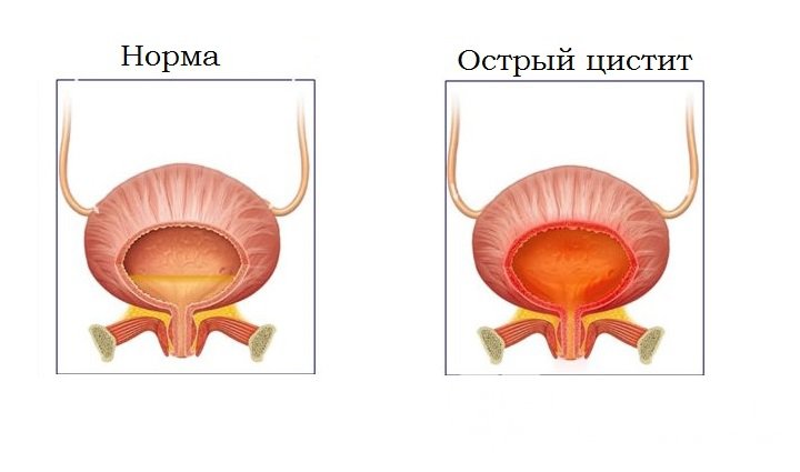 Признаки острого цистита