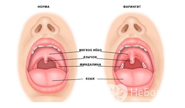 Симптомы острого фарингита