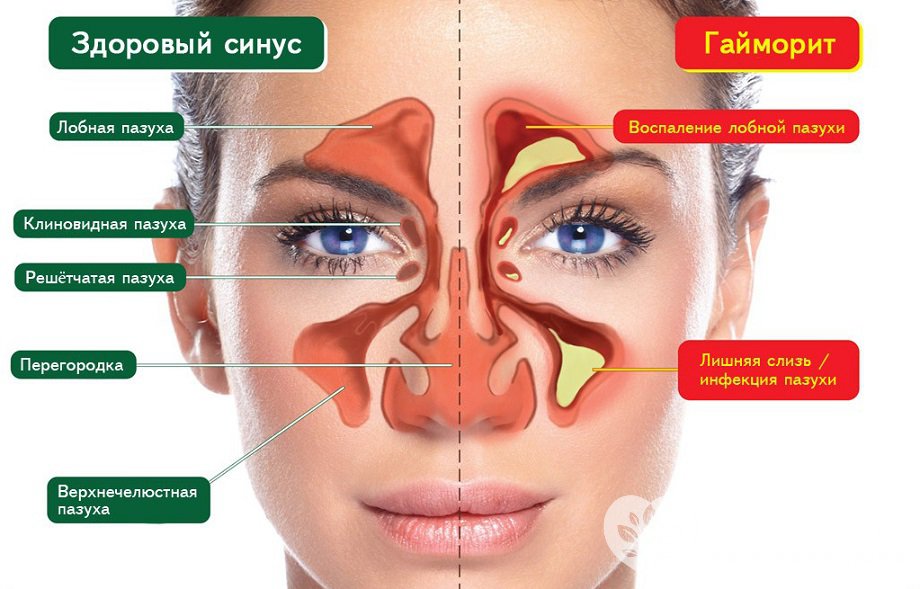 Симптомы острого гайморита