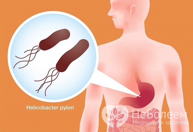 Иммуноферментный анализ помогает определить инфицирование бактерией Helicobacter pylori