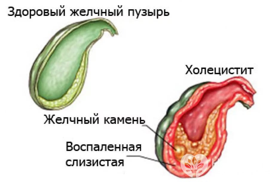 Признаки острого холецистита