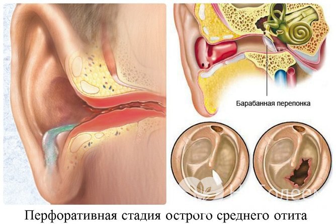 Стадии острого отита