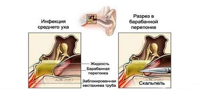 Парацентез при остром отите
