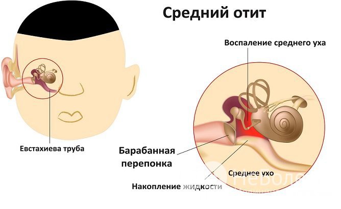 Причины отита у детей и факторы риска