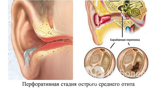 Перфорация барабанной перепонки при остром среднем отите