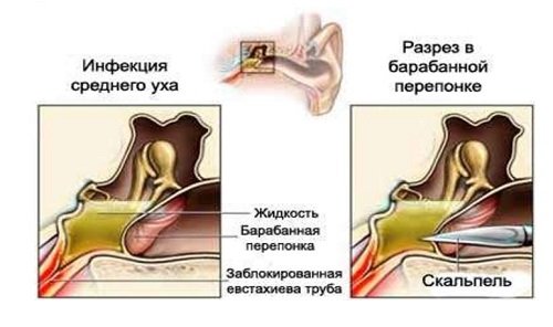 Парацентез при отите у детей