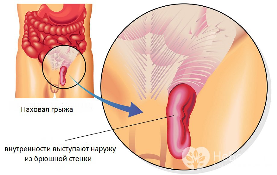 Признаки паховой грыжи у мужчин