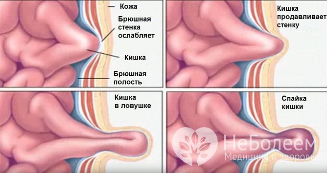 Процесс образования паховой грыжи