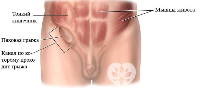 Основной симптом паховой грыжи – опухолевидное выпячивание в области паха