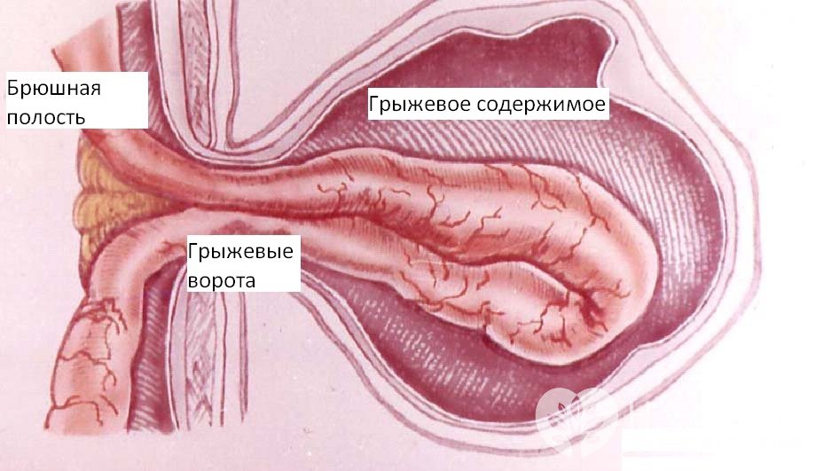 Признаки паховой грыжи