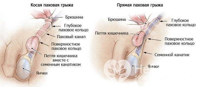 Косая и прямая паховые грыжи