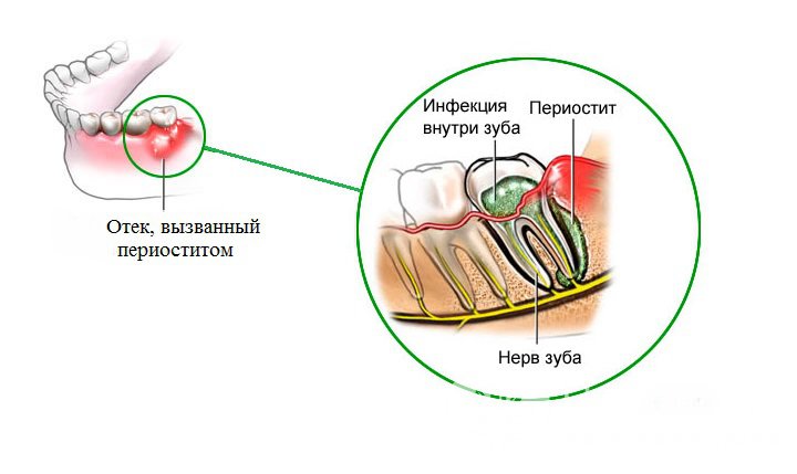 Признаки периостита