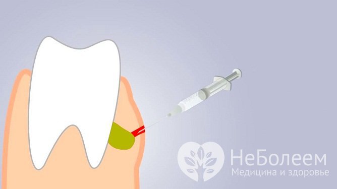 При гнойном процессе показано разрезание десны и сбор гноя