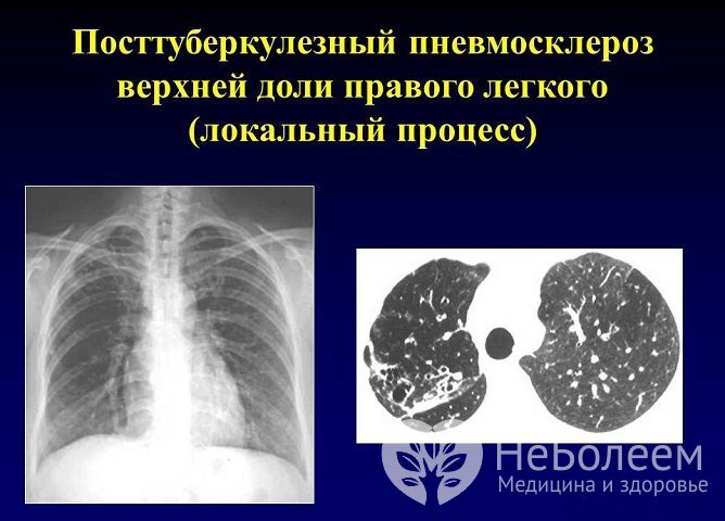 Рентгенологический снимок при пневмосклерозе