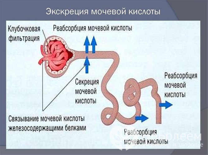 Самой распространенной причиной подагрического артрита является сниженная экскреция мочевой кислоты в организме