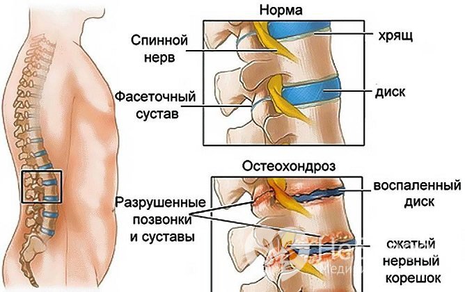 Поясничный остеохондроз: симптомы и лечение