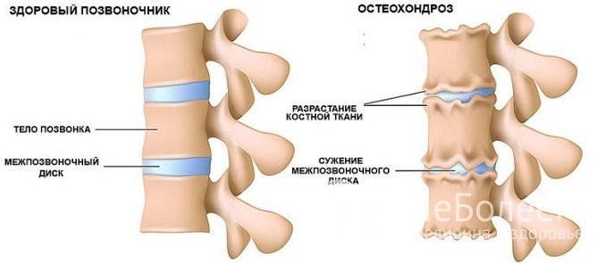 Симптомы поясничного остеохондроза