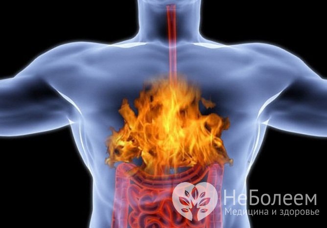 Изжога – основной симптом повышенной кислотности желудка
