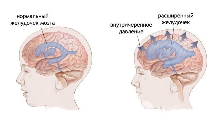 Признаки повышенного внутричерепного давления