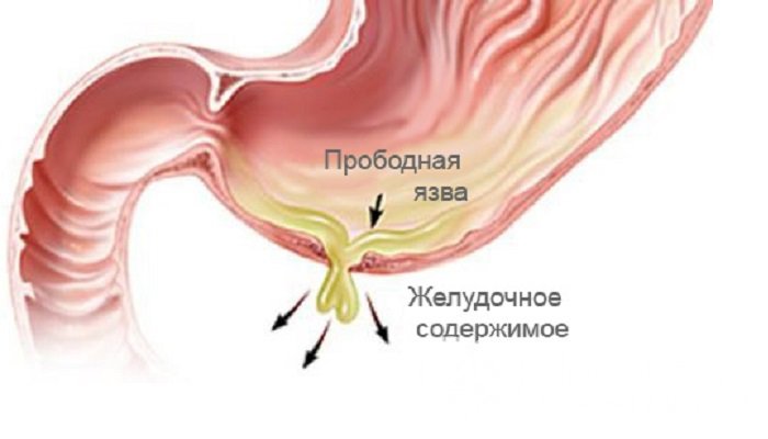 Признаки прободной язвы