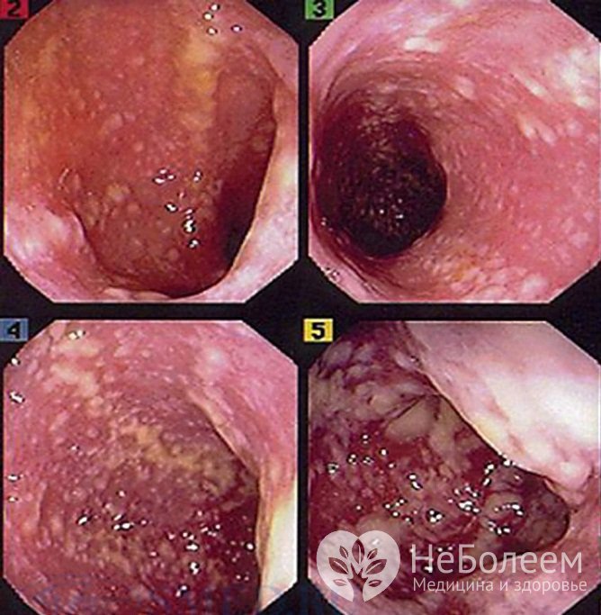 Псевдомембранозный колит по результатам колоноскопии