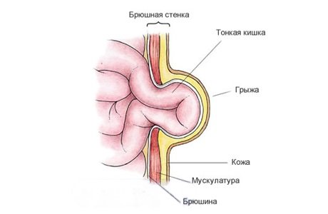 Эмбриональные пупочные грыжи у детей возникают из-за недоразвития передней брюшной стенки