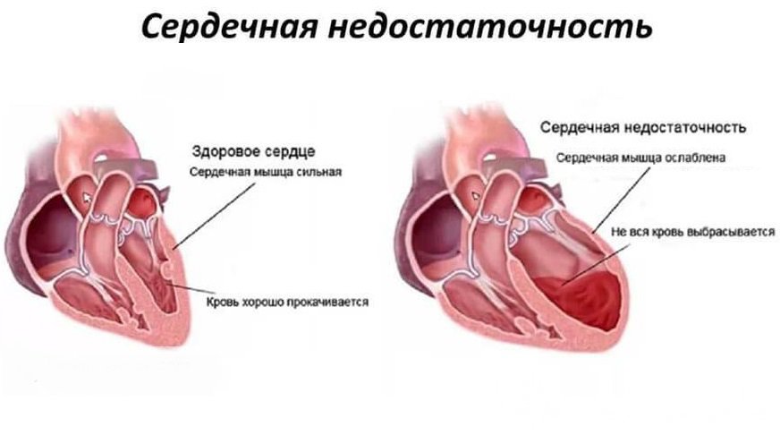 Признаки сердечной недостаточности